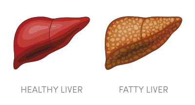 fatty liver vs healthy liver